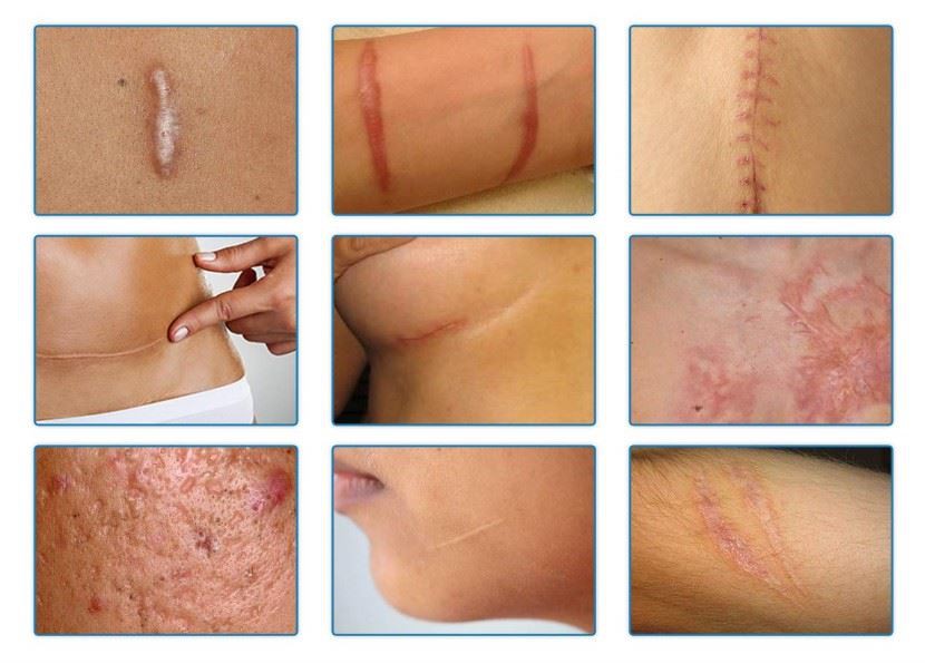 silicone gel sheet 11 silicone gel sheet 11